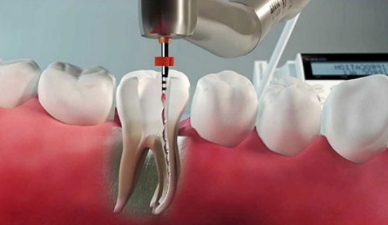 Root Canal Treatment